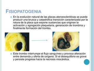 FISIOPATOGENIA
 En la evolución natural de las placas ateroescleróticas se puede
producir una brusca y catastrófica transición caracterizada por la
rotura de la placa que expone sustancias que originan la
activación y agregación plaquetaria, generación de trombina y
finalmente formación del trombo.
 Este trombo interrumpe el flujo sanguíneo y provoca alteración
entre demanda y oferta de oxígeno. Si el desequilibrio es grave
y persiste progresa hacia la necrosis miocárdica.
 