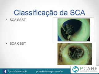 pcarefisioterapia.com.br/pcarefisioterapia
Classificação da SCA
• SCA SSST
• SCA CSST
 