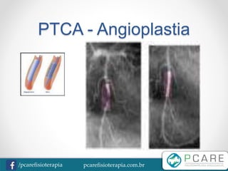 pcarefisioterapia.com.br/pcarefisioterapia
PTCA - Angioplastia
 