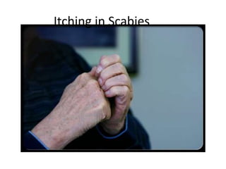 Itching in Scabies
 