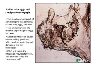 Scabies mite, eggs, and
stool photomicrograph

This is a photomicrograph of
a skin scraping that contains a
scabies mite, eggs, and feces
This animal burrows into
the skin, depositing both eggs
and feces
A scabies infestation causes
intense itching (pruritus)
which leads to scratching and
damage of the skin
(excoriation)
If left untreated, the
infestation may last for years,
and has been called the
"seven year itch".
 