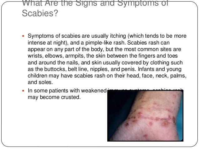 What are the symptoms of a scabies infection?