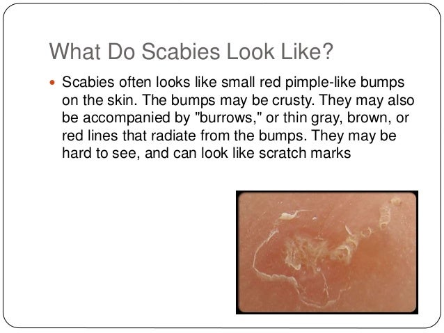 Scabies Pictures: Rash, Skin Infections, Itching, Symptoms ...