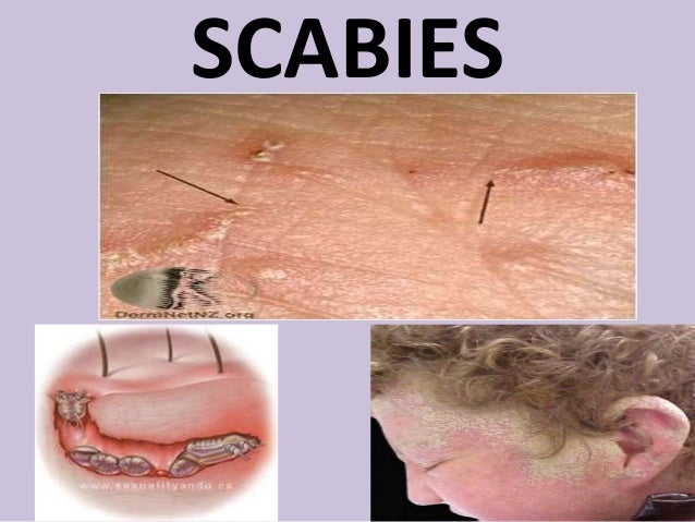 Scabies On Face Pics