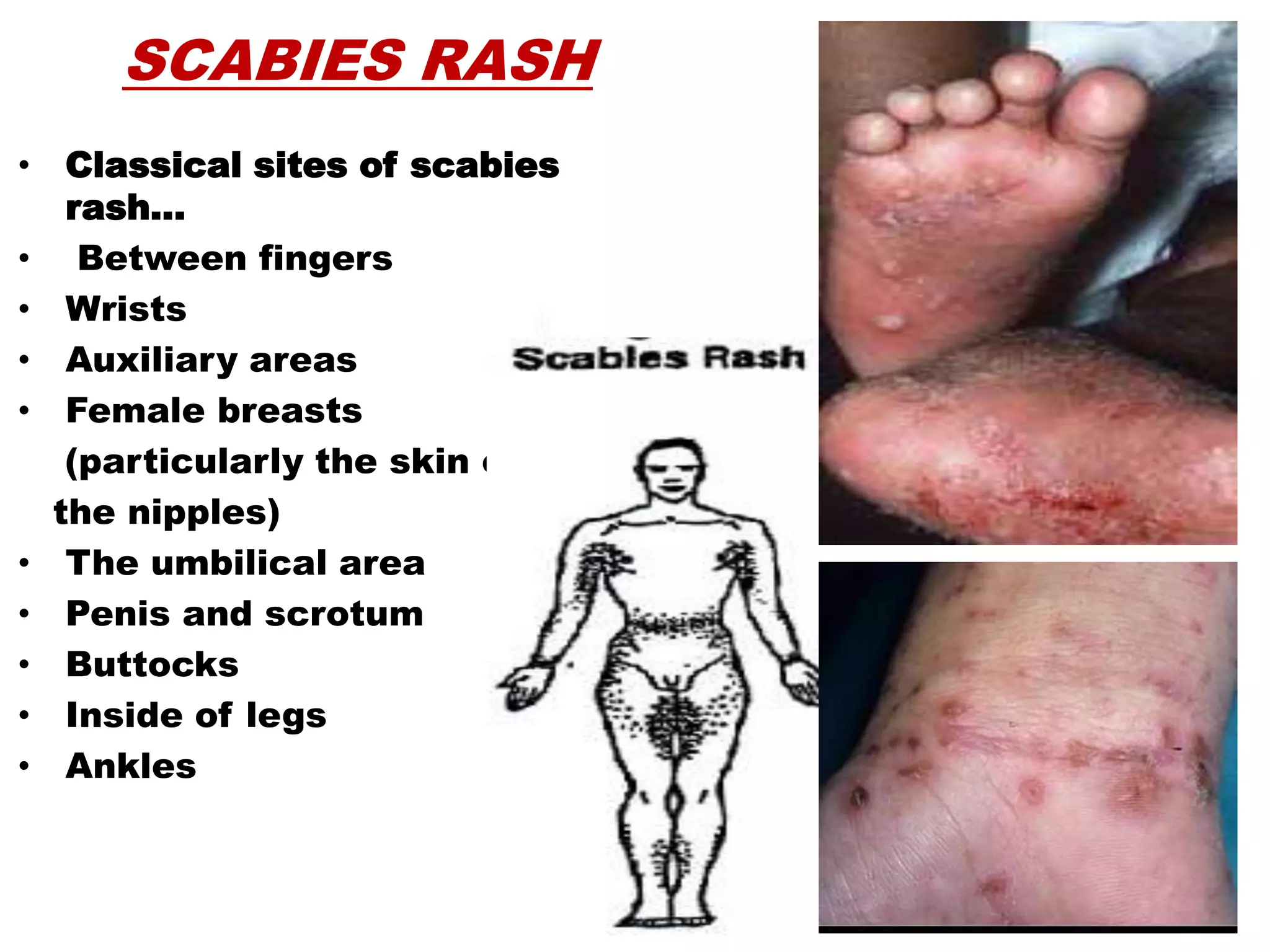 Scabies PPTX Scabies PPTX