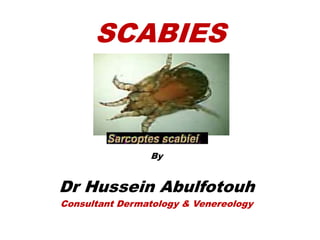 SCABIES
By
Dr Hussein Abulfotouh
Consultant Dermatology & Venereology
 