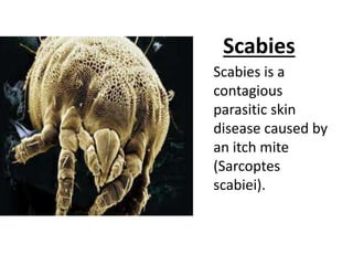 Scabies
Scabies is a
contagious
parasitic skin
disease caused by
an itch mite
(Sarcoptes
scabiei).
 