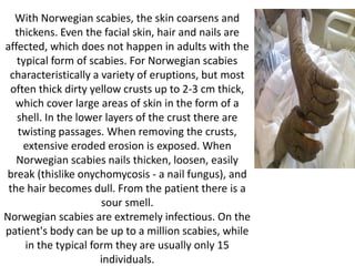 With Norwegian scabies, the skin coarsens and
thickens. Even the facial skin, hair and nails are
affected, which does not happen in adults with the
typical form of scabies. For Norwegian scabies
characteristically a variety of eruptions, but most
often thick dirty yellow crusts up to 2-3 cm thick,
which cover large areas of skin in the form of a
shell. In the lower layers of the crust there are
twisting passages. When removing the crusts,
extensive eroded erosion is exposed. When
Norwegian scabies nails thicken, loosen, easily
break (thislike onychomycosis - a nail fungus), and
the hair becomes dull. From the patient there is a
sour smell.
Norwegian scabies are extremely infectious. On the
patient's body can be up to a million scabies, while
in the typical form they are usually only 15
individuals.
 