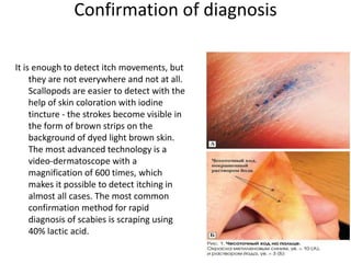 Confirmation of diagnosis
It is enough to detect itch movements, but
they are not everywhere and not at all.
Scallopods are easier to detect with the
help of skin coloration with iodine
tincture - the strokes become visible in
the form of brown strips on the
background of dyed light brown skin.
The most advanced technology is a
video-dermatoscope with a
magnification of 600 times, which
makes it possible to detect itching in
almost all cases. The most common
confirmation method for rapid
diagnosis of scabies is scraping using
40% lactic acid.
 