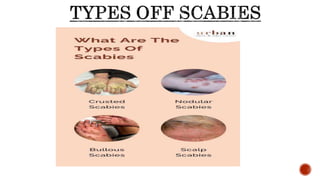 scabies.pptx