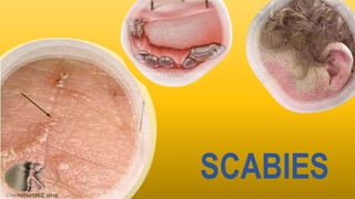 SCABIES
 
