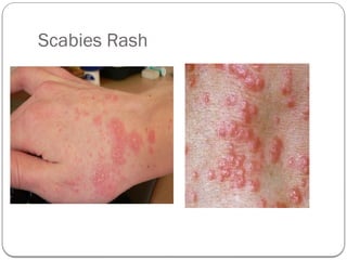 Scabies Rch Scabies in adolescents kid's and community.pptx