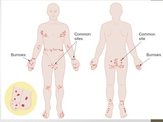 Shaps Infection Comprehensive Overview of Parasitic Skin Infections: Scabies and Beyond ...