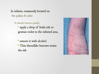Burrow Ink Testing Comprehensive Overview of Parasitic Skin Infections: Scabies and Beyond ...
