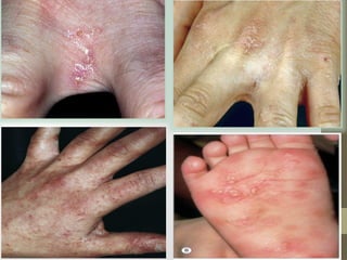 Parasite Rashes Comprehensive Overview of Parasitic Skin Infections: Scabies and Beyond ...