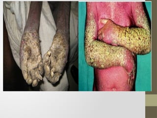 Parasitic Skin Rashes Comprehensive Overview of Parasitic Skin Infections: Scabies and Beyond ...