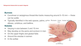 Scabies- Current Views in Dermatovenereology[1].pptx