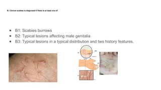 Scabies- Current Views in Dermatovenereology[1].pptx