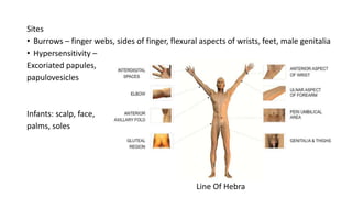 Sites
• Burrows – finger webs, sides of finger, flexural aspects of wrists, feet, male genitalia
• Hypersensitivity –
Excoriated papules,
papulovesicles
Infants: scalp, face,
palms, soles
Line Of Hebra
 
