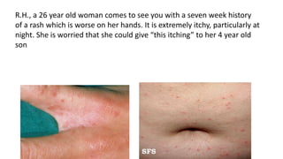 R.H., a 26 year old woman comes to see you with a seven week history
of a rash which is worse on her hands. It is extremely itchy, particularly at
night. She is worried that she could give “this itching” to her 4 year old
son
 