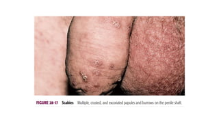 SCABIES Awajo.pptx