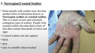 SCABIES BY DR MALZ.pptx