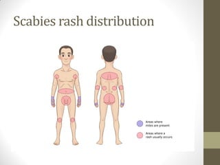Typical Scabies Rash Scabies, cellulitis ihope ping | PDF