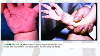 Scabies [Derma] smol.pptxbees bees bees bees | PPTX