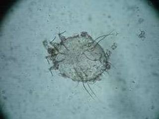 Scabies Micro Video Scabies lecture.pptx