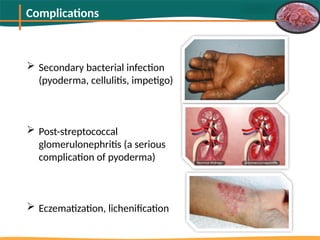 Pyoderma Bacterial Infection Scabies Outbreak In Bangladesh & It's Management-MSD.pptx