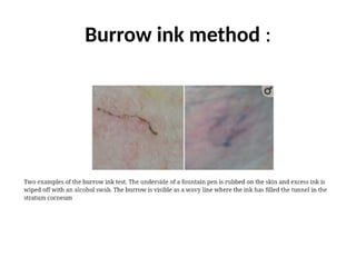 Burrow Ink Testing Scabies Pediculosis UG.pptxhvgvgvvvtvtvtvvtbtbtv | PPTX