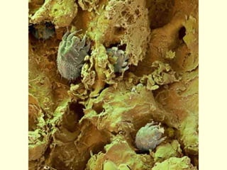 Scabies ppt
