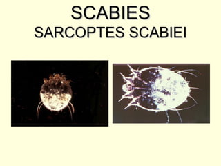 SCABIESSCABIES
SARCOPTES SCABIEISARCOPTES SCABIEI
 