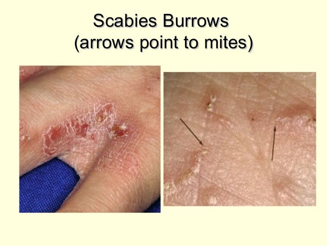 scabies tracks