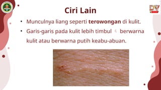 Ciri Lain
• Munculnya liang seperti terowongan di kulit.
• Garis-garis pada kulit lebih timbul  berwarna
kulit atau berwarna putih keabu-abuan.
 