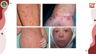 Scabies PPT dr.SASTRI adalah pengetahuan .pptx
