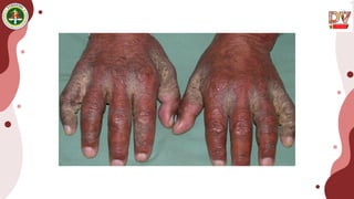 Scabies PPT dr.SASTRI adalah pengetahuan .pptx