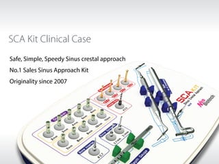 SCA Kit Clinical Case
Safe, Simple, Speedy Sinus crestal approach
No.1 Sales Sinus Approach Kit
Originality since 2007
 