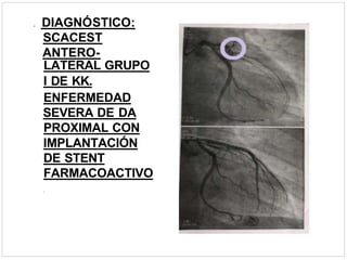 . DIAGNÓSTICO:
SCACEST
ANTERO-
LATERAL GRUPO
I DE KK.
ENFERMEDAD
SEVERA DE DA
PROXIMAL CON
IMPLANTACIÓN
DE STENT
FARMACOACTIVO
.
 