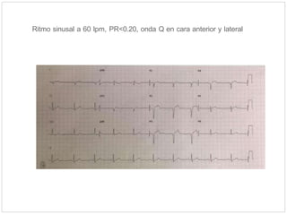 Ritmo sinusal a 60 lpm, PR<0.20, onda Q en cara anterior y lateral
 