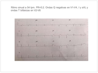 Ritmo sinual a 54 lpm. PR<0.2. Ondas Q negativas en V1-V4, I y aVL y
ondas T bifásicas en V2-V6
 