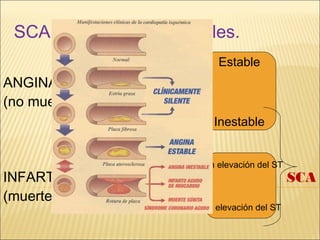 SCA: diferencias esenciales.
ANGINA
(no muerte celular)
INFARTO SCA
(muerte celular)
Estable
Inestable
Con elevación del ST
Sin elevación del ST
 