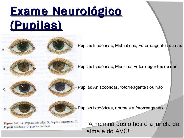 Pupilas Isocóricas E Fotorreagentes – TLAJ