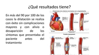 ¿Qué resultados tiene?
En más del 90 por 100 de los
casos la dilatación se realiza
con éxito sin complicaciones
mayores y con alivio o
desaparición de los
síntomas que presentaba el
paciente antes del
tratamiento
 