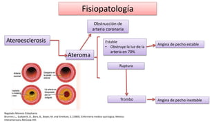 Fisiopatología
Regalado Moreno Estephania
Brunner, L., Suddarth, D., Bare, B., Boyer, M. and Smeltzer, S. (1989). Enfermería medico quirúrgica. Mexico:
Interamericana McGraw-Hill.
Ateroesclerosis
Obstrucción de
arteria coronaria
Ateroma
Estable
• Obstruye la luz de la
arteria en 70%
Ruptura
Trombo
Angina de pecho estable
Angina de pecho inestable
 