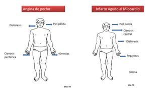 Angina de pecho Infarto Agudo al Miocardio
Piel pálida Piel pálida
Húmedas
Pegajosas
Edema
Diaforesis
Diaforesis
Cianosis
periférica
Cianosis
central
 