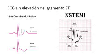 S ndrome Coronario Agudo Sin Elevaci n Del Segmento ST PPTX s-ndrome-coronario-agudo-sin-elevaci-n-del-segmento-st-pptx