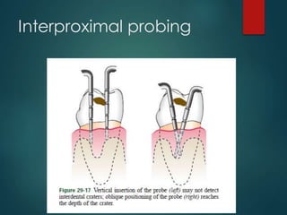 Interproximal probing
 