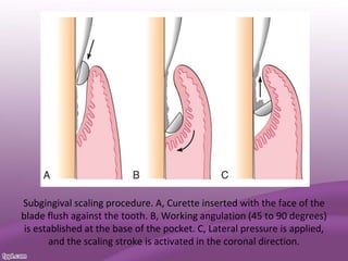 Subgingival scaling procedure. A, Curette inserted with the face of the
blade flush against the tooth. B, Working angulation (45 to 90 degrees)
is established at the base of the pocket. C, Lateral pressure is applied,
and the scaling stroke is activated in the coronal direction.
 