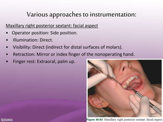 Various approaches to instrumentation:
Maxillary right posterior sextant: facial aspect
• Operator position: Side position.
• Illumination: Direct.
• Visibility: Direct (indirect for distal surfaces of molars).
• Retraction: Mirror or index finger of the nonoperating hand.
• Finger rest: Extraoral, palm up.
 